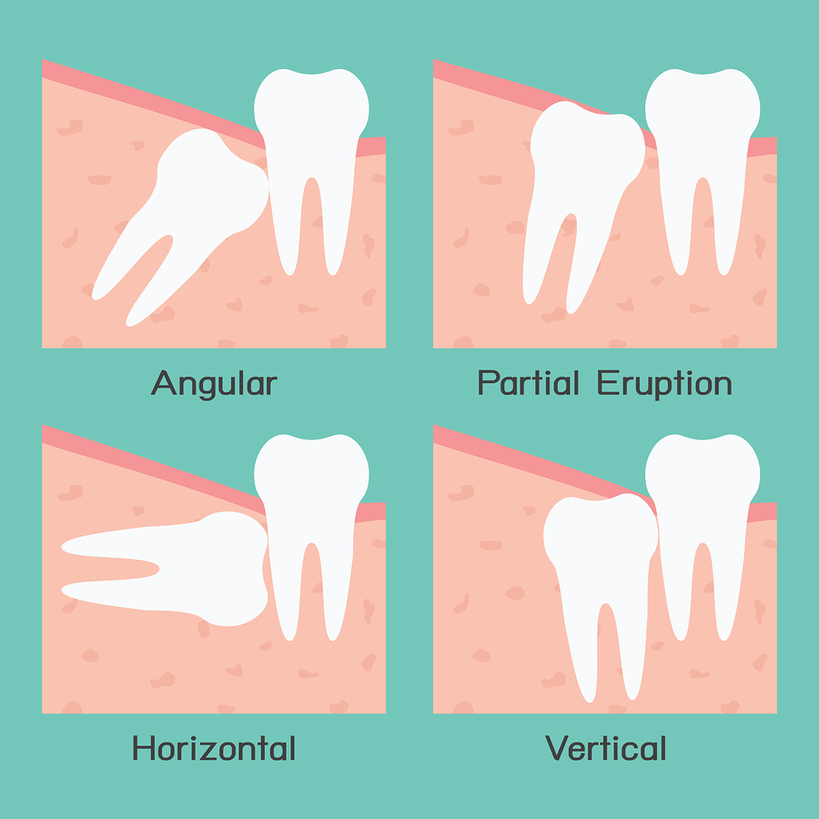 How Wisdom Teeth Removal Infection can Save You Time, Stress, and Money.